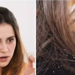Monsoon Hair Care: వర్షాకాలంలో వచ్చే చుండ్రు నివారణకు నేచురల్ రెమెడీస్ !