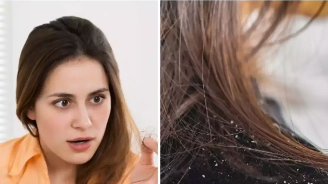 Monsoon Hair Care: వర్షాకాలంలో వచ్చే చుండ్రు నివారణకు నేచురల్ రెమెడీస్ !