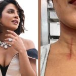Priyanka Chopra: బ్రేకింగ్ న్యూస్.. షూటింగ్‌లో గాయపడిన ప్రియాంక చోప్రా