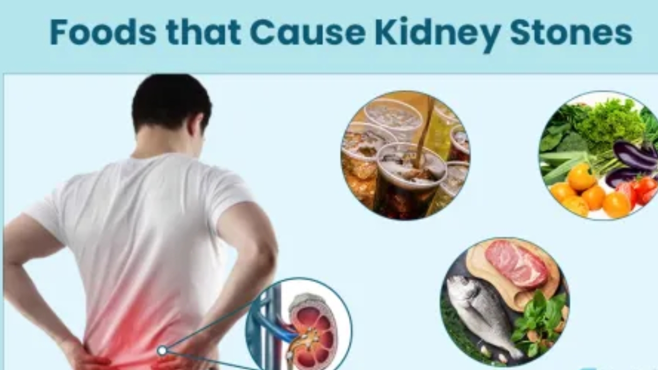 Kidney Stones Causes Food: ఈ ఆహారాలు తింటున్నారా..? అయితే కిడ్నీ స్టోన్స్ గ్యారంటీ..!