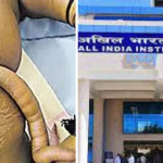 Rare Surgery in AIIMS Bibinagar: అరుదైన శస్త్ర చికిత్స.. బాలుడికి తోకని తొలగించిన ఎయిమ్స్‌ వైద్యులు..!