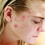 Tips to Prevent Pimples: ఈ టిప్స్ ఫాలో అయితే ముఖంపై ఒక్క మొటిమ కూడా ఉండదు