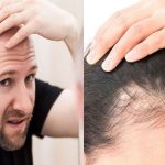 Hair Fall Tips: జుట్టు ఎక్కువగా రాలి బట్టతల వస్తుందా? ఈ జాగ్రత్తలు పాటించండి!