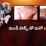 Monkey Pox Virus: వణికిస్తున్న మంకీ పాక్స్.. మరో లాక్ డౌన్ తప్పదా?