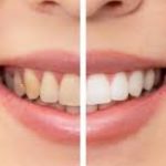 Remedies For Teeth Whitening: దంతాలు పసుపు రంగులో ఉన్నాయని ఇబ్బంది పడుతున్నారా.. ఈ చిట్కాలు వాడి మెరిపించేయండి