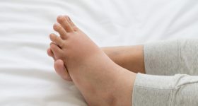Kidney Disease: కాళ్ల వాపు కిడ్నీ వ్యాధులకు సంకేతమా ?