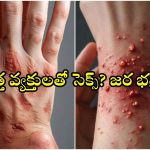 Mpox in Hyderabad: భయపెడుతున్న ఎంపాక్స్ వైరస్.. హైదరాబాద్‌కు ముప్పు?