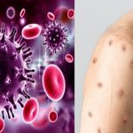 Monkeypox: మంకీపాక్స్ కూడా ఎయిడ్స్ లాంటిదేనా? ఎలా వ్యాపిస్తుంది?