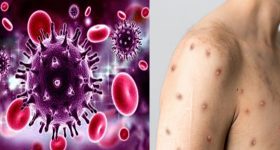 Monkeypox: మంకీపాక్స్ కూడా ఎయిడ్స్ లాంటిదేనా? ఎలా వ్యాపిస్తుంది?