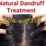 Home Remedies For Dandruff : డాండ్రఫ్ తో బాధపడుతున్నారా?.. ఈ చిట్కాలు మీ కోసమే..