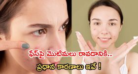 Causes Of Pimples: మొటిమలు రావడానికి కారణాలు ఇవే !