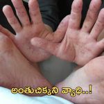 Hand Foot Mouth: రాష్ట్రంలో ‘హ్యాండ్ ఫుట్ మౌత్’ కలకలం.. వ్యాధి లక్షణాలు ఇవే!