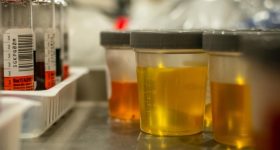Urine: మూత్రం ఆ రంగులో వస్తుందా? ప్రాణాలు పోతాయ్ జాగ్రత్త!