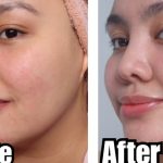 Pimple Problem: వీటితో ముఖంపై మచ్చలు పోతాయ్