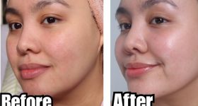 Pimple Problem: వీటితో ముఖంపై మచ్చలు పోతాయ్
