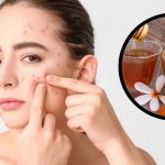 Pimples On Face: వీటిని వాడితే మీ ముఖంపై మొటిమలు రమ్మన్నా.. రావు