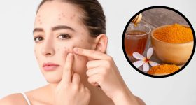 Pimples On Face: వీటిని వాడితే మీ ముఖంపై మొటిమలు రమ్మన్నా.. రావు