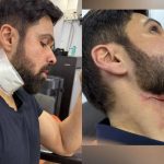 Emraan Hashmi: బ్రేకింగ్.. షూటింగ్ లో గాయాల పాలైన ఓజీ విలన్
