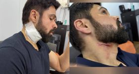 Emraan Hashmi: బ్రేకింగ్.. షూటింగ్ లో గాయాల పాలైన ఓజీ విలన్