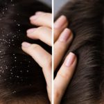 Dandruff: చుండ్రు ఈజీగా తగ్గించుకోండిలా ?