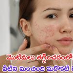 Oily Skin: ముఖంపై మొటిమలను తగ్గించడంలో వీటిని మించింది లేదు