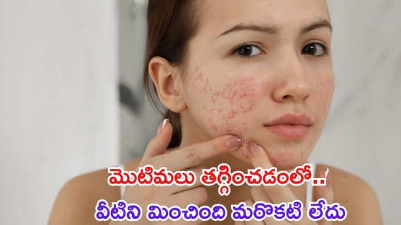 Oily Skin: ముఖంపై మొటిమలను తగ్గించడంలో వీటిని మించింది లేదు