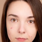 Pimple Problem: ఇంట్లోనే మొటిమలను తగ్గించే మార్గాలివే