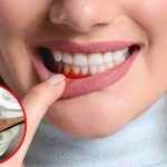 Bleeding Gums: చిగుళ్ల నుంచి రక్తం కారుతోందా ? ఇలా చేస్తే సమస్య దూరం