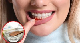 Bleeding Gums: చిగుళ్ల నుంచి రక్తం కారుతోందా ? ఇలా చేస్తే సమస్య దూరం