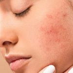 Black Spots Removal: ముఖంపై నల్ల మచ్చలు తొలగిపోవాలంటే.. ఇలా చేయండి