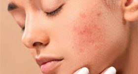Black Spots Removal: ముఖంపై నల్ల మచ్చలు తొలగిపోవాలంటే.. ఇలా చేయండి