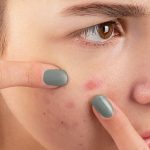 Acne: మొటిమలను గోళ్లతో గిల్లడం మొదలుపెట్టారా? అది మచ్చలకే కాదు, ఇంకెన్నో సమస్యలకు కారణం అవుతాయి