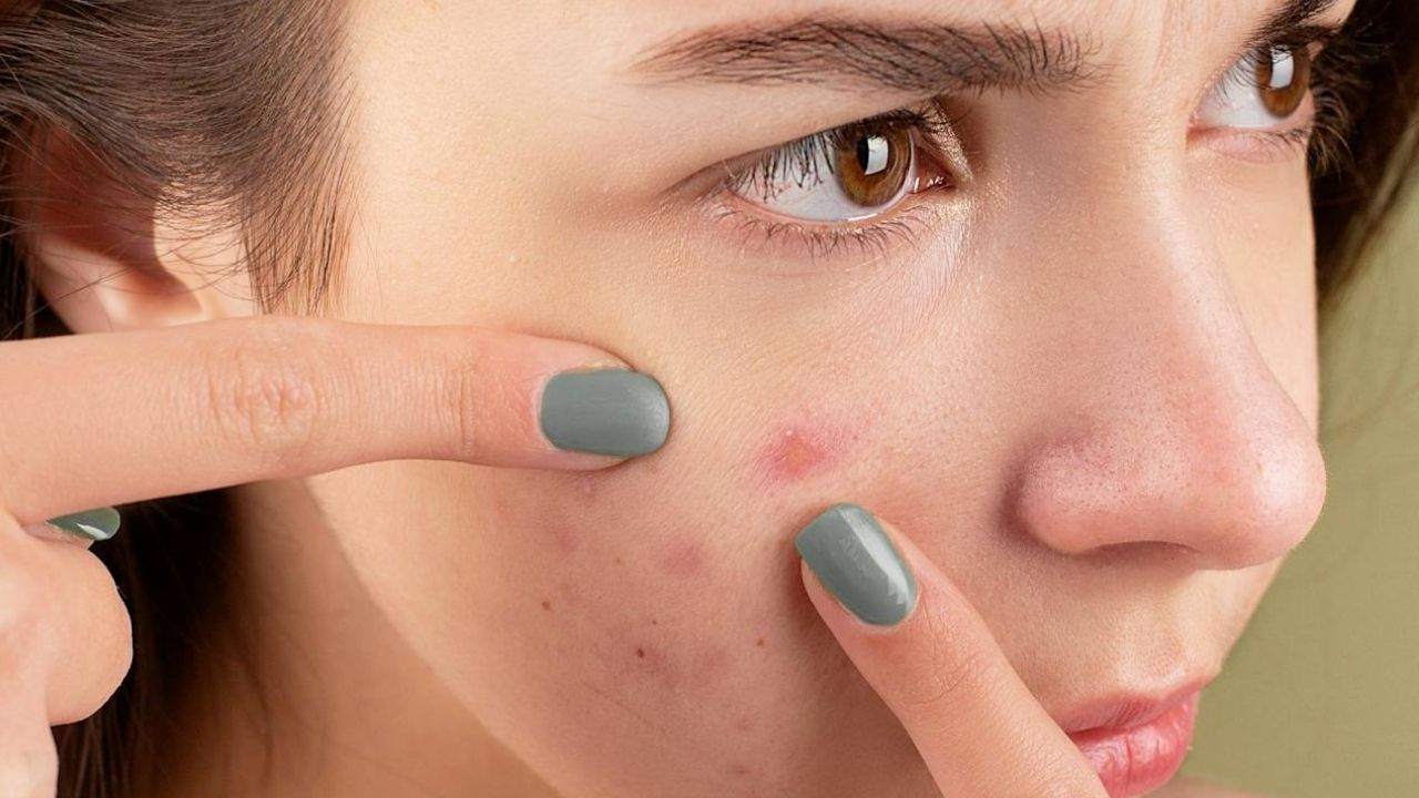 Acne: మొటిమలను గోళ్లతో గిల్లడం మొదలుపెట్టారా? అది మచ్చలకే కాదు, ఇంకెన్నో సమస్యలకు కారణం అవుతాయి
