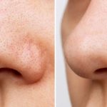 Blackheads: బ్లాక్ హెడ్స్ మీ అందాన్ని తగ్గిస్తున్నాయా ? ఓ సారి వీటిని ట్రై చేయండి