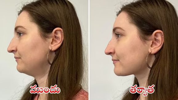 Double Chin:డబుల్ చిన్‌తో ఇబ్బంది పడుతున్నారా ? ఈ చిట్కాలతో సమస్య పరార్ !