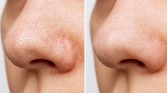 Blackheads: బ్లాక్ హెడ్స్ మీ అందాన్ని తగ్గిస్తున్నాయా ? ఓ సారి వీటిని ట్రై చేయండి