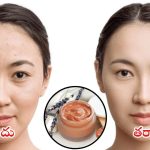 Pimples Problems: ఇలా చేస్తే.. ముఖంపై మొటిమలు మాయం