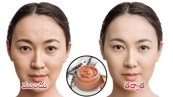 Pimples Problems: ఇలా చేస్తే.. ముఖంపై మొటిమలు మాయం
