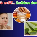 Pimple Problem: వీటితో మొటిమలకు చెక్ పెట్టండిలా !