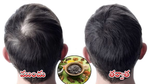 Tips For Hair Fall: బట్టతలపై కూడా జుట్టు రావాలంటే.. వీటిని పక్కా వాడాల్సిందే !