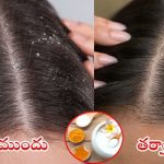 Tips For Dandruff: వీటితో.. చుండ్రుకు చెప్పండి గుడ్ బై