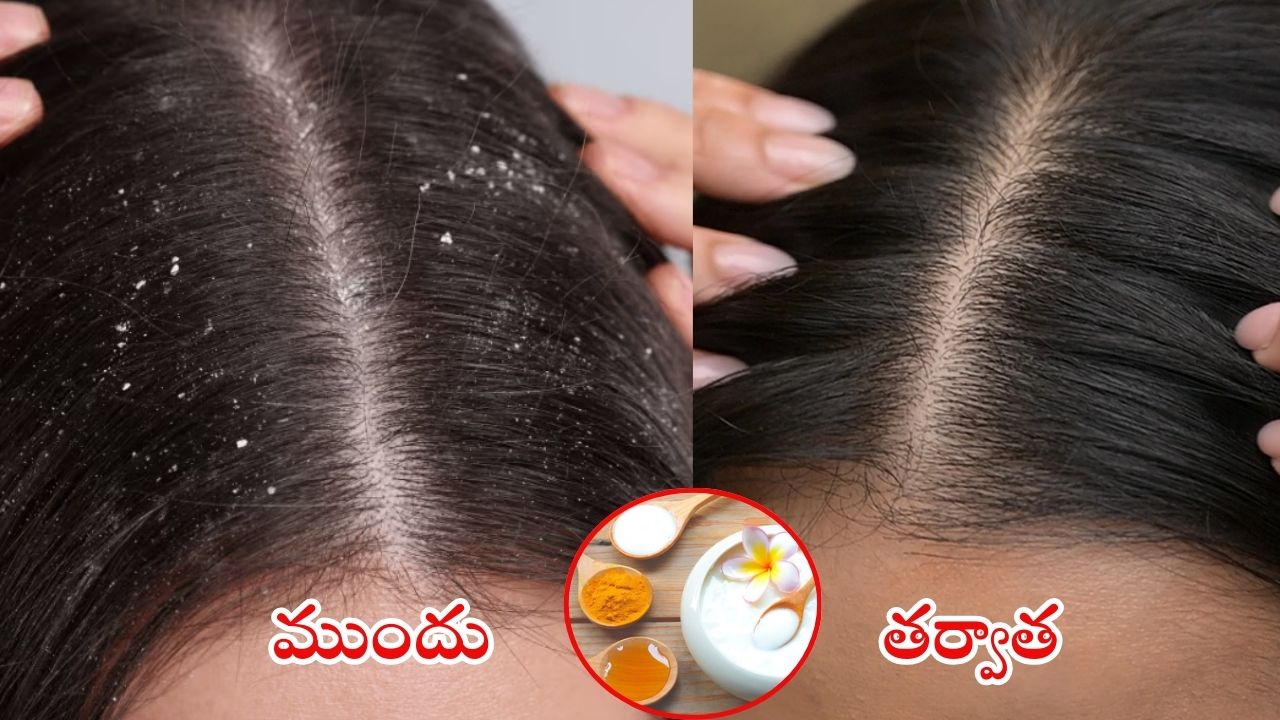Tips For Dandruff: వీటితో.. చుండ్రుకు చెప్పండి గుడ్ బై