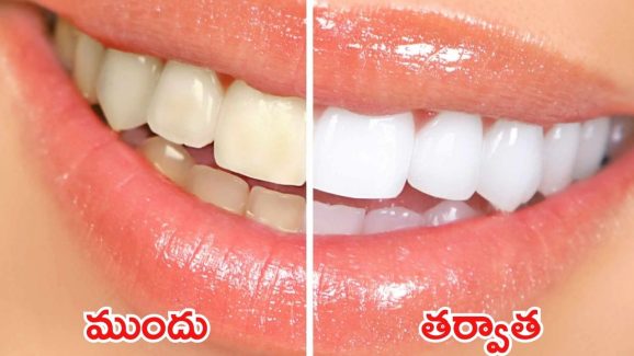 Tips For Yellow Teeth: ఇలా చేస్తే.. క్షణాల్లోనే మీ పళ్లు మెరిసిపోతాయ్