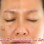 Pigmentation: ఇలా చేస్తే.. ముఖంపై మంగు మచ్చలు మాయం