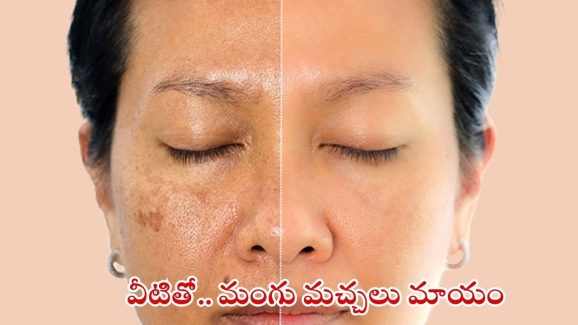 Pigmentation: ఇలా చేస్తే.. ముఖంపై మంగు మచ్చలు మాయం