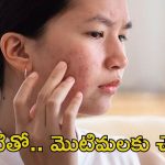 Pimple Problem: వీటిని వాడితే.. ఈజీగా మొటిమలు మాయం