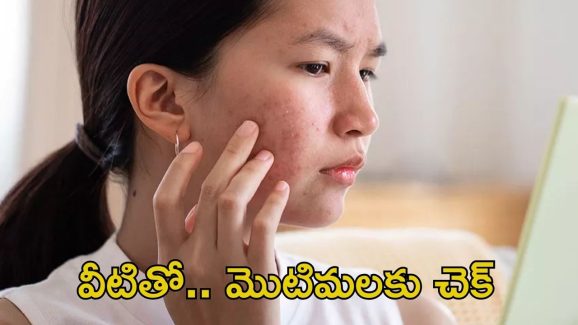 Pimple Problem: వీటిని వాడితే.. ఈజీగా మొటిమలు మాయం