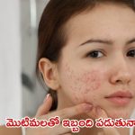 Pimple Marks: మొటిమలు, మచ్చలతో ఇబ్బంది పడుతున్నారా ?