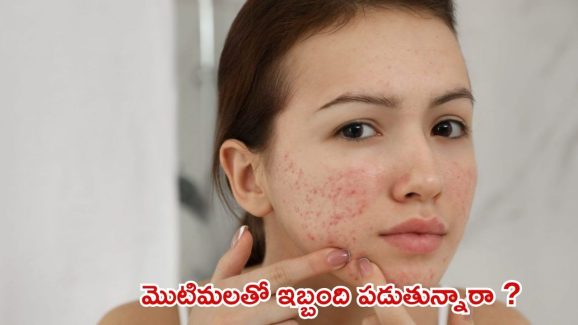 Pimple Marks: మొటిమలు, మచ్చలతో ఇబ్బంది పడుతున్నారా ?