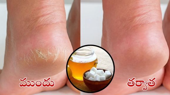 Cracked Heels: కాళ్ల పగుళ్లు వెంటనే తగ్గాలంటే.. కర్పూరంలో ఇవి కలిపి వాడండి